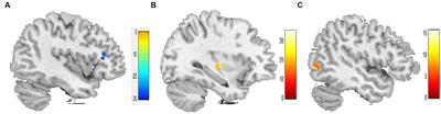 Immediate neural effects of acupuncture manipulation time for stroke with motor dysfunction: a fMRI pilot study